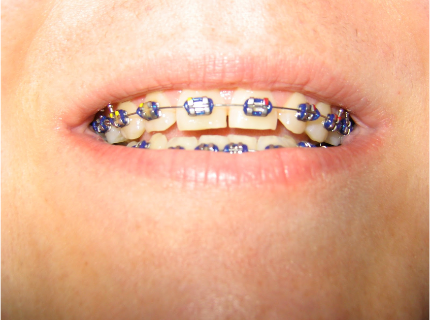 تقويم الاسنان المعدني 